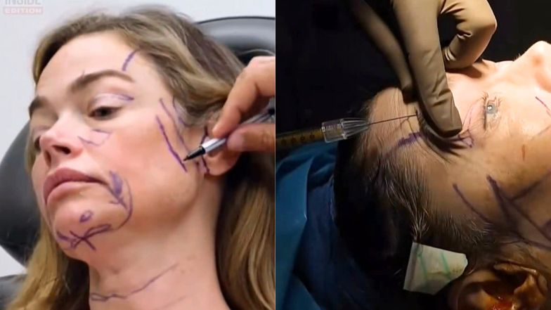 Denise Richards pokazała nagranie z liftingu twarzy