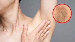 Pojawia się pod pachami. Znak, że cukrzyca już dewastuje trzustkę