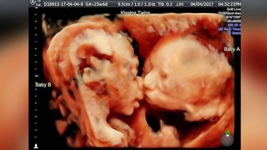 Była w szoku, kiedy zobaczyła USG. Badanie ujawniło nietypowe zachowanie bliźniaczek