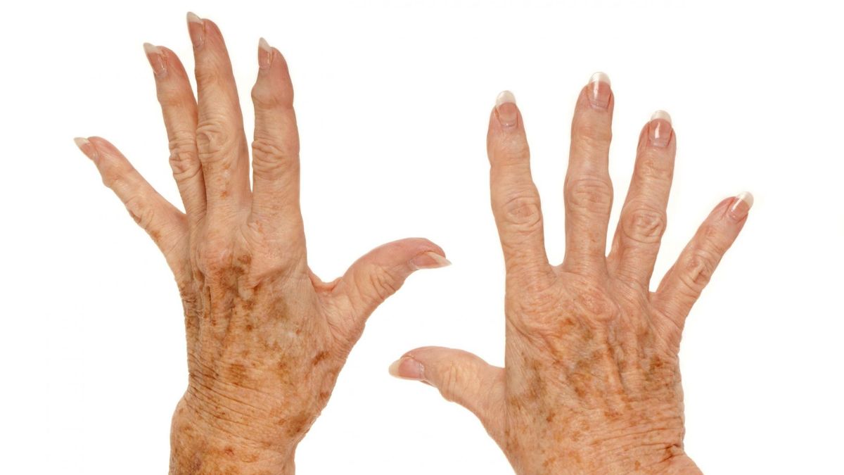 Plamy wątrobowe często pojawiają się na dłoniach i dekolcie.