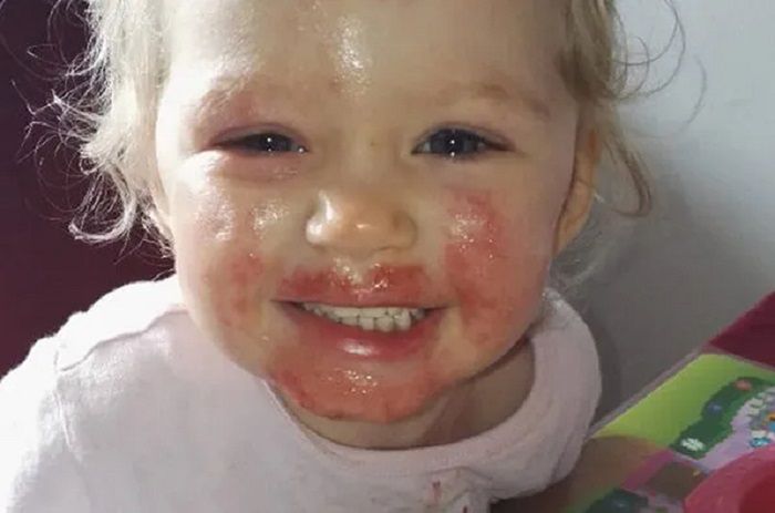 Wysypka nasilała się coraz bardziej