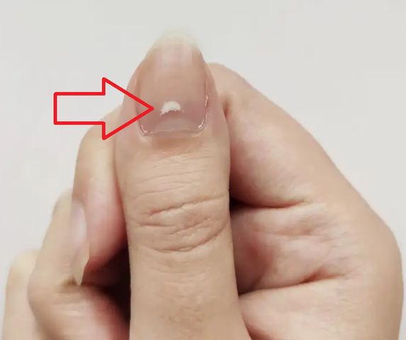 Białe plamy to nie zawsze objaw uszkodzenia paznokcia