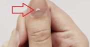 Zauważysz je na paznokciach. To może być objaw poważnej choroby