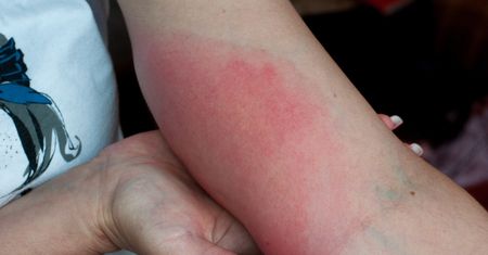 Zespół poboreliozowy – leczenie, objawy i przyczyny