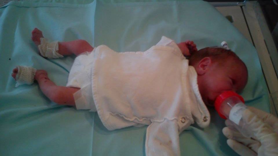 Michalinka cierpi na EB, czyli pęcherzowe oddzielanie się naskórka