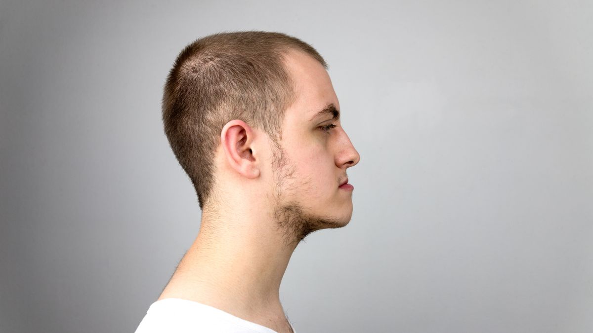 Progenia może objawiać się asymetrią rysów twarzy