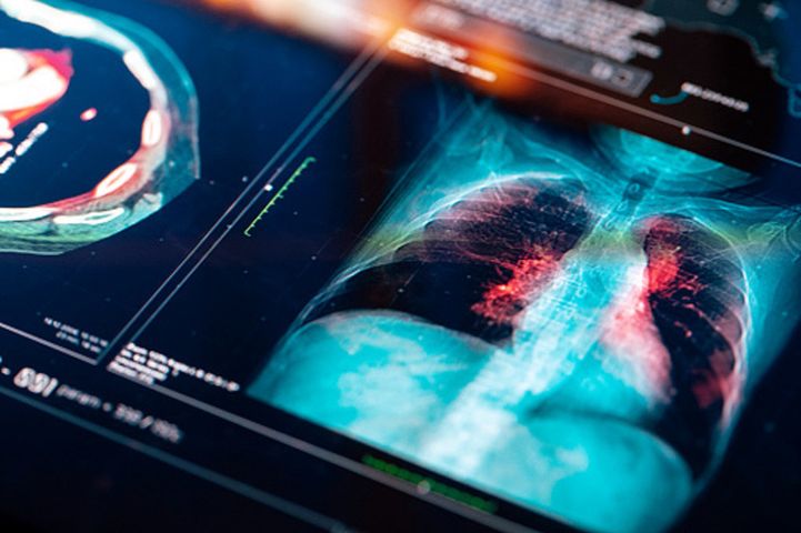 5 objawów, które mogą być oznaką śmiertelnego raka płuc