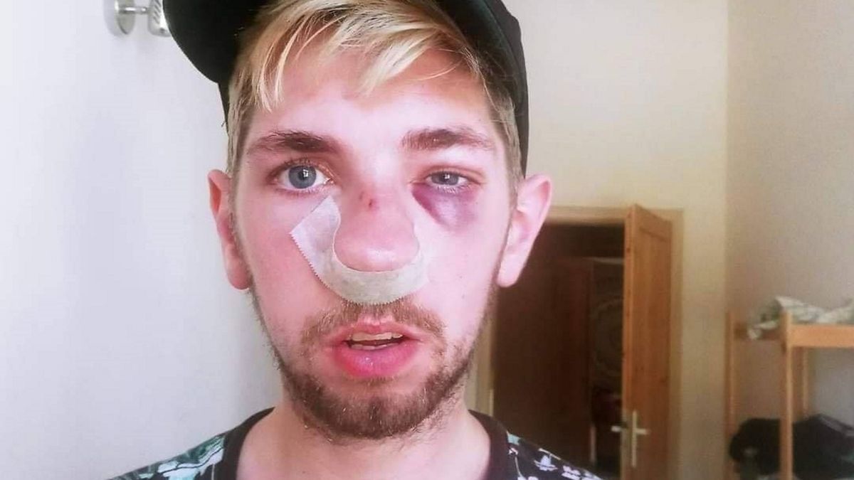 Pobity Miłosz opisał brutalny napad, jakiego doświadczył w mediach społecznościowych. 