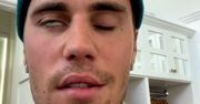 Justin Bieber sparaliżowany. Zespół Ramsaya Hunta. Co to za choroba?