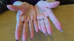 Wczesny objaw raka płuc. Może występować aż u 35 proc. pacjentów