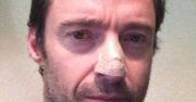 ''Wolverine'': U Hugh Jackmana zdiagnozowano raka