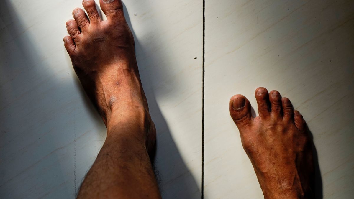 Jakie objawy daje dna moczanowa?