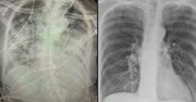 Koronawirus. Pokazali płuca ozdrowieńców COVID-19. Gorsze niż przez lata palenia papierosów