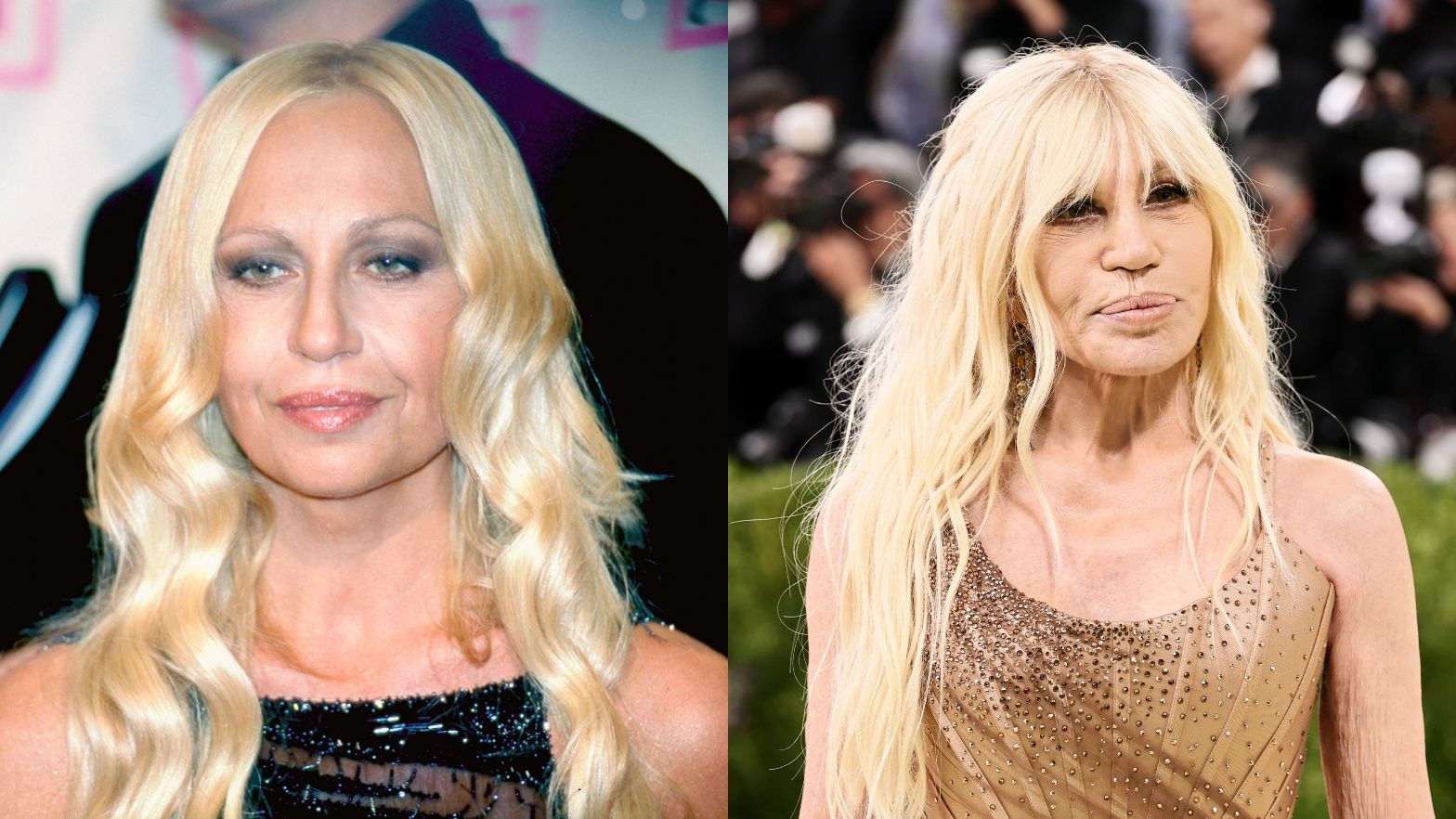Donatella Versace przed i po liftingu 