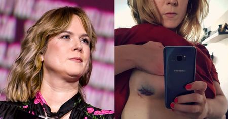 Anna Tatarska z "Dzień Dobry TVN" pokazała ślad po biopsji piersi. Opowiedziała o paraliżującym strachu: "Głowa wariuje" (FOTO)