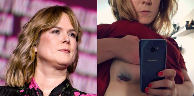 Anna Tatarska z "Dzień Dobry TVN" pokazała ślad po biopsji piersi. Opowiedziała o paraliżującym strachu: "Głowa wariuje" (FOTO)
