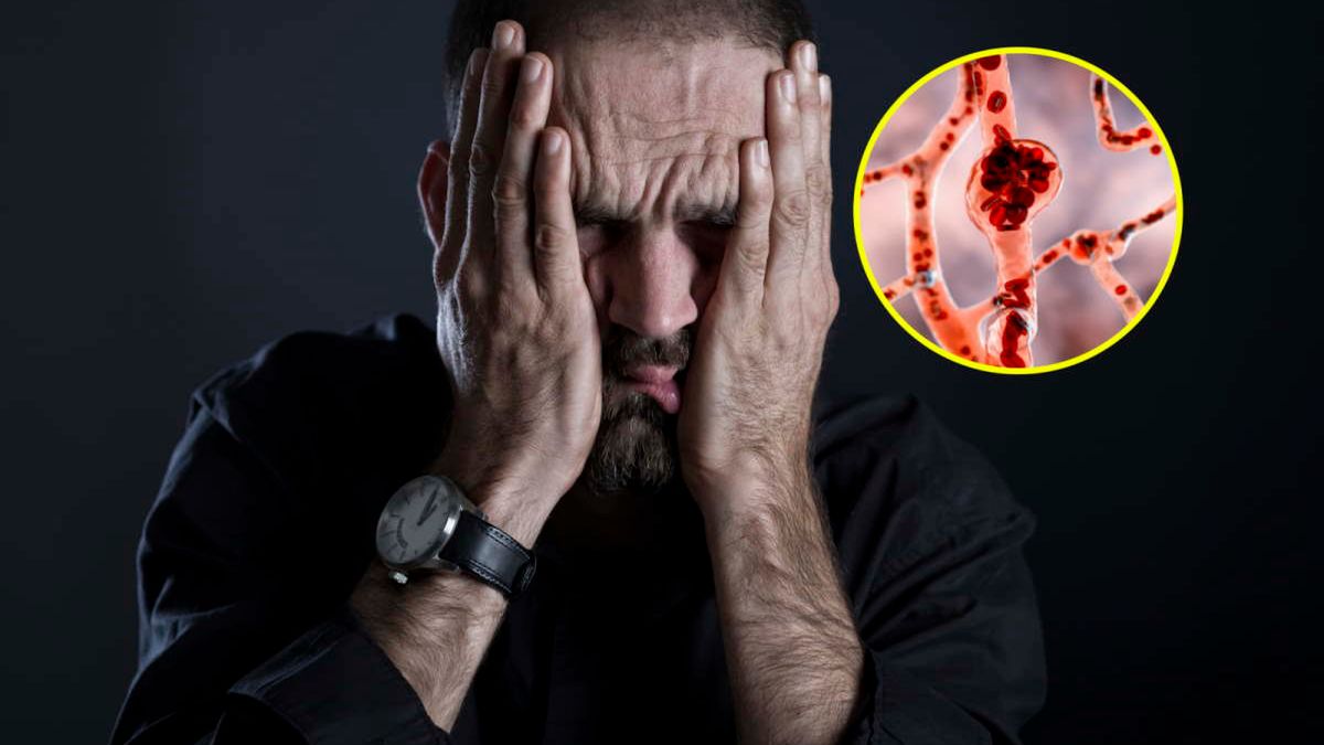 Silny ból głowy może świadczyć o tętniaku