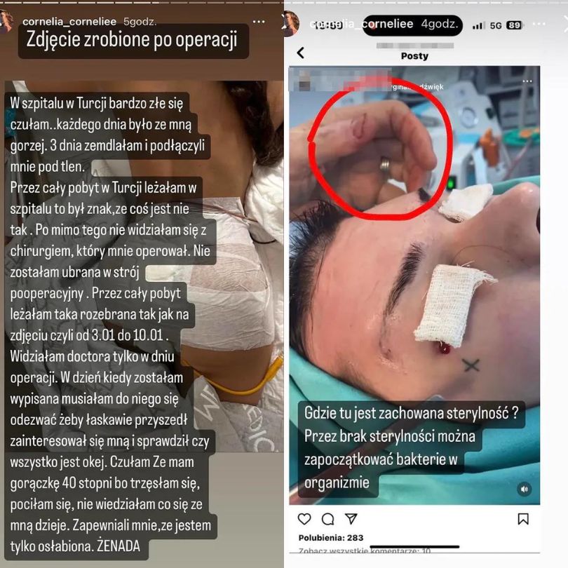 Polska influencerka wspomina horror po zabiegu w tureckiej klinice