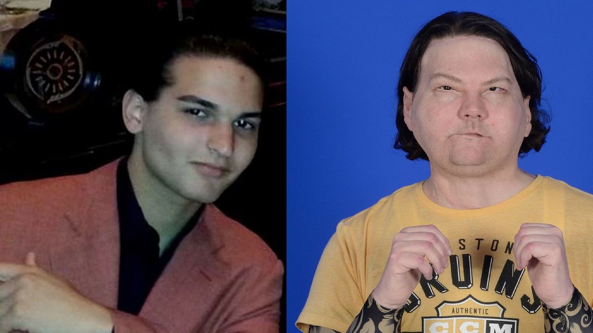 Joe DiMeo przed i po przeszczepie twarzy i rąk