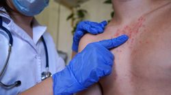 WHO ostrzega przed groźnym wirusem. Polacy stracili odporność populacyjną