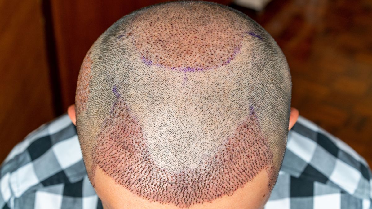 Przeszczepy włosów odznaczają się coraz wyższą skutecznością