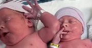 Kiedy się urodziły, lekarz był w szoku. Nigdy nie widział takich bliźniaków