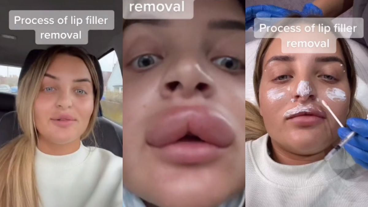 Tiktokerka pokazała, jak wyglądało u niej usunięcie wypełniaczy z ust 