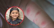 Rodzice sądzili, że ich dziecko ugryzł owad. Diagnoza była dużo gorsza
