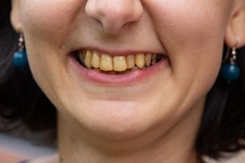 Długość życia zapisana w zębach. Naukowcy już wiedzą