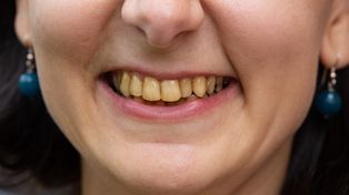 Długość życia zapisana w zębach. Naukowcy już wiedzą