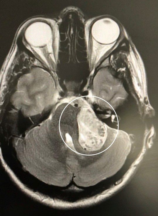 Guz został zdiagnozowany jako nerwiak słuchu