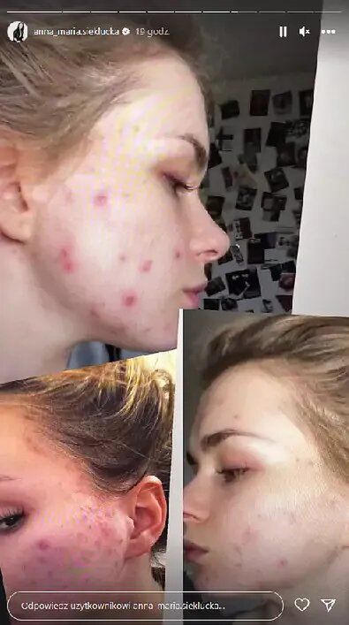 Anna Maria Sieklucka miała problemy z cerą