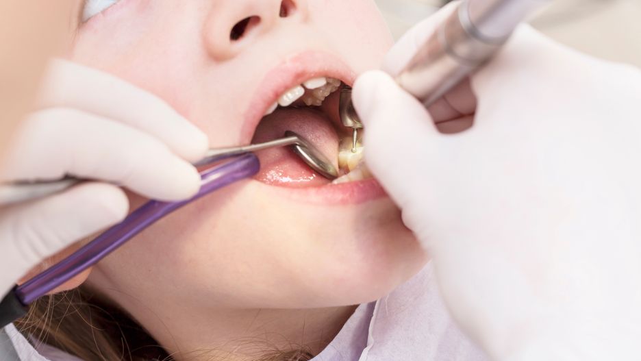 dentysta, plomba, dentystyczny, pierwszy, mleczny, osoba, stomatologia, owoc, ból.leczenie, wiercenie, gabinet, dziura, nowy, opieka, pusty, utrata, strach, otwarty, lekarz, blond, dziecko, wizyta u dentysty