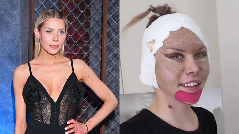 Julia von Stein pokazała zliftingowaną twarz 13 dni po operacji