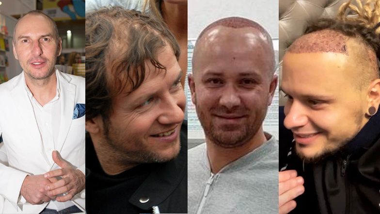 Oni przeszczepili sobie włosy 