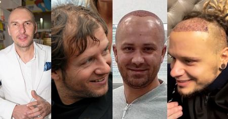 Oni PRZESZCZEPILI SOBIE WŁOSY! Teraz wyglądają lepiej? (ZDJĘCIA)