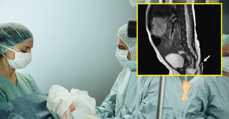 Na porodówce zdębieli. Dziewczynka urodziła się z ogonem