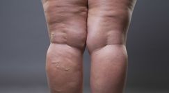 Grube nogi mogą być objawem choroby