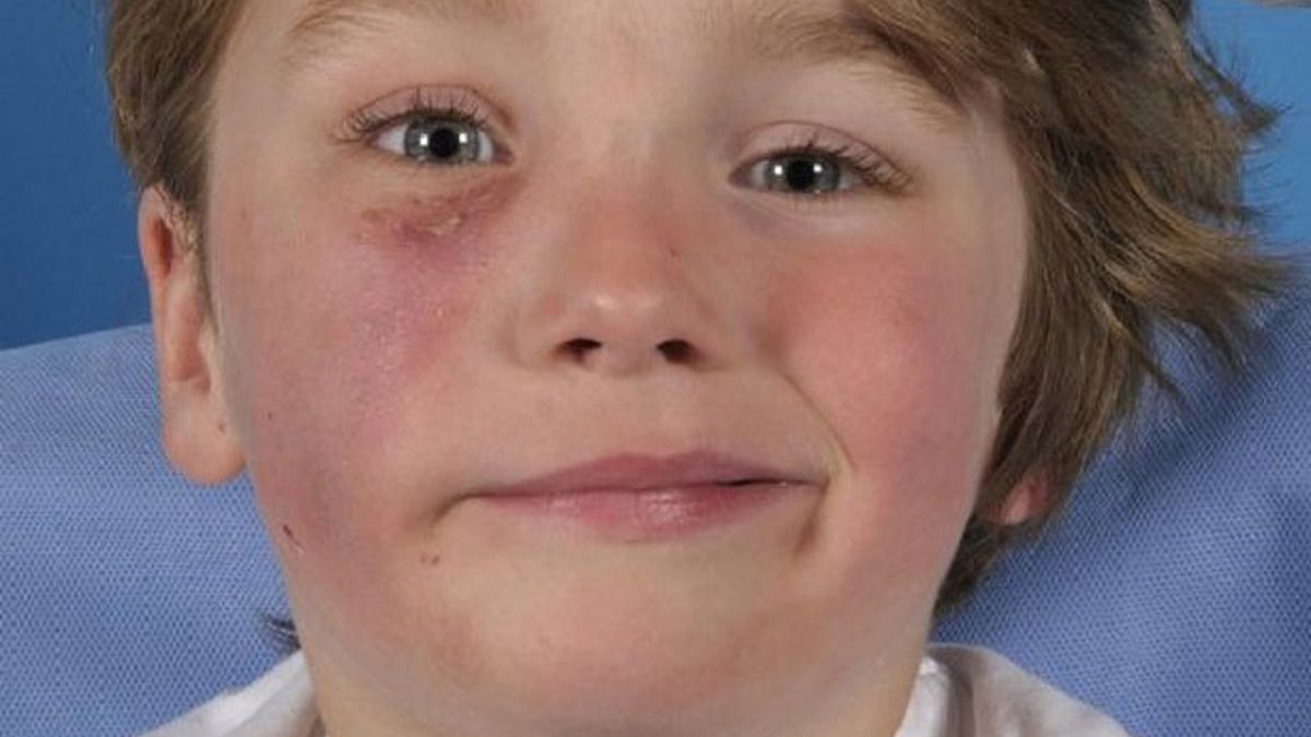 Chłopiec został ugryziony w twarz przez kobrę podczas snu.