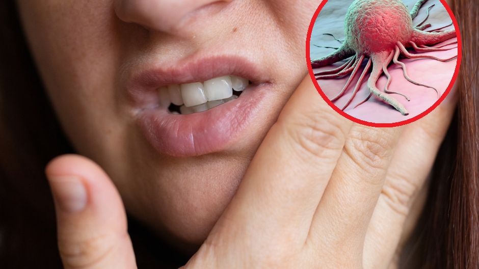 Bakterie z rodzaju Fusobacterium mają zdolność do zabijania komórek rakowych w nowotworach głowy i szyi