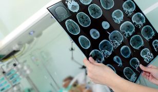 Stymulacja mózgu prądem wybudza ze śpiączki i poprawia intelekt