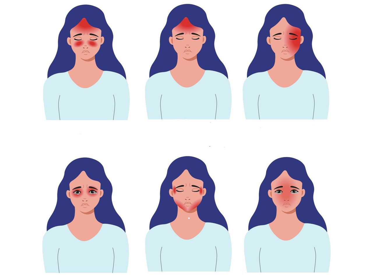 Mapa bólu głowy. Co oznacza ból głowy w danym miejscu? Naucz się rozpoznawać rodzaje bólu głowy po ich umiejscowieniu