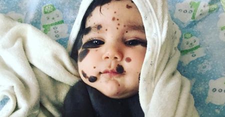 "Chłopiec panda" niedługo skończy trzy lata. Lekarze dawali mu 10 dni życia