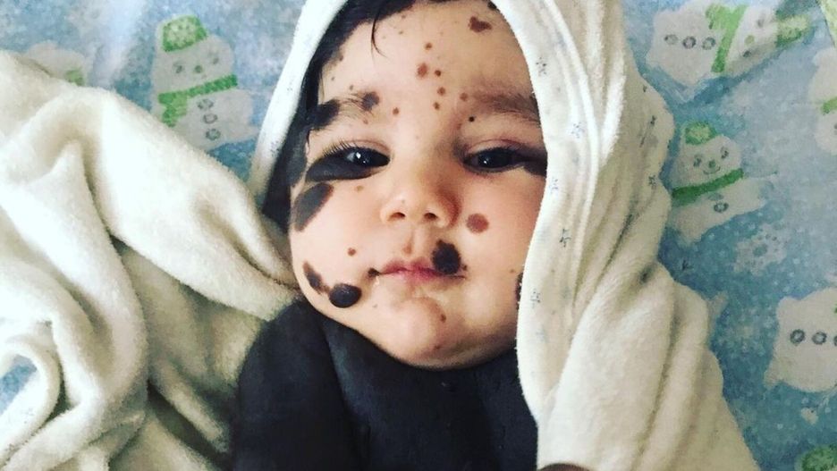 "Chłopiec-panda" niedługo skończy trzy lata