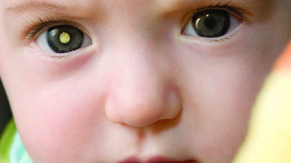 Czy zauważyłeś "złote oczy" na fotografiach twojego dziecka? To może być nowotwór