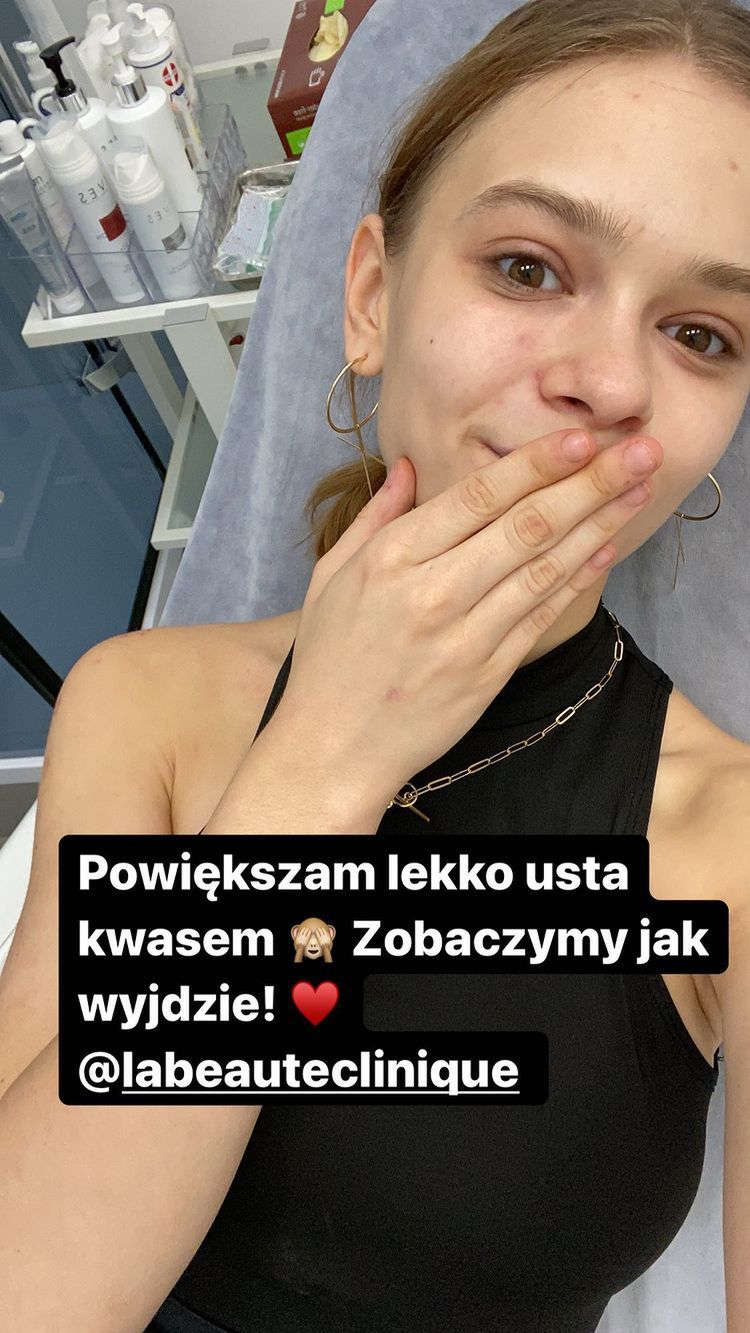 Julia Wróblewska powiększyła usta