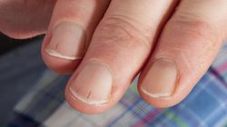 Nie lekceważ zmian na paznokciach. To może być czerniak