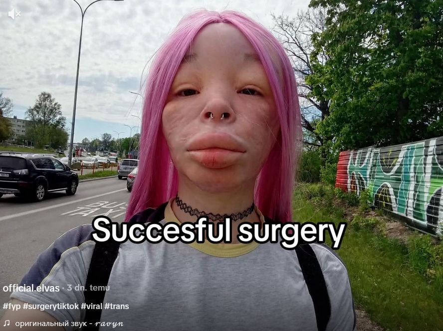 Elva po operacji