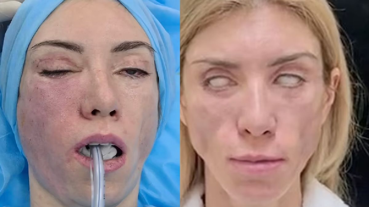 Julia Tarasewicz poddała się zabiegowi liftingu.