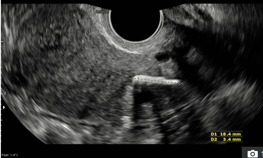 Miała aborcję 20 lat temu. W ciele pozostała kość płodu, która uniemożliwiała zajście w ciążę